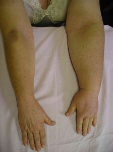 Secondary Lymphoedema affecting the whole arm and hand