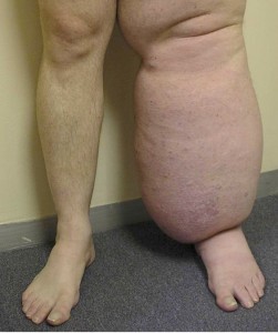 Grade Three Lymphoedema- Note the skin changes, large skin fold around the ankle and in this case severe oedema.