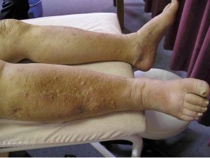 Grade Three Lymphoedema- Skin changes are evident with disclolouration, papillomata and thickening. Note also the beginning of skin folds developing at the ankle.