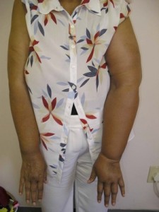 Lymphoedema01