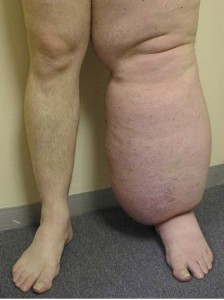 Lymphoedema03