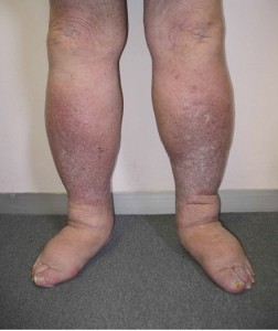 Phlebolymphoedema. This type of oedema is a combination of vascular and lymphatic problems.