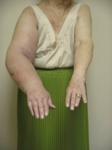 Lymphoedema of the arm
